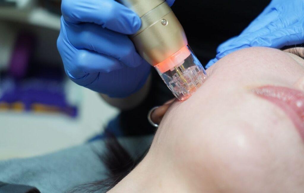 rf microneedling Singapore.
