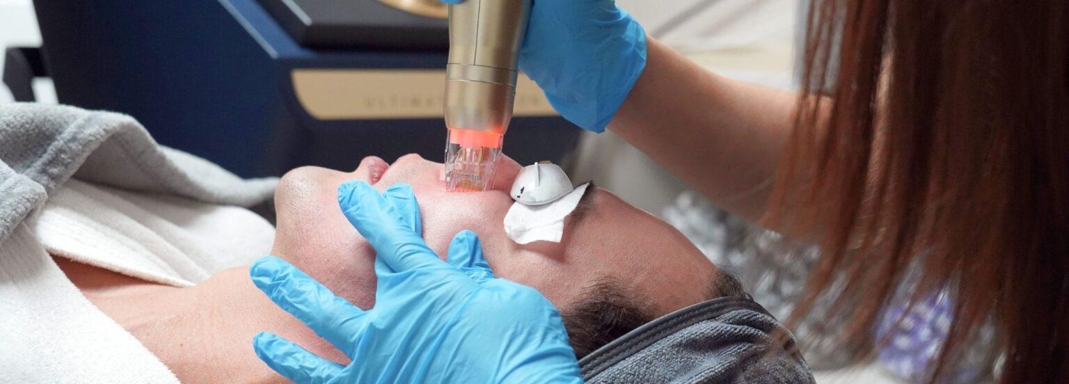 benefits of rf microneedling.