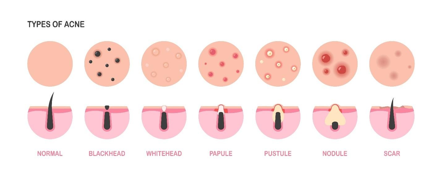 types of acne.