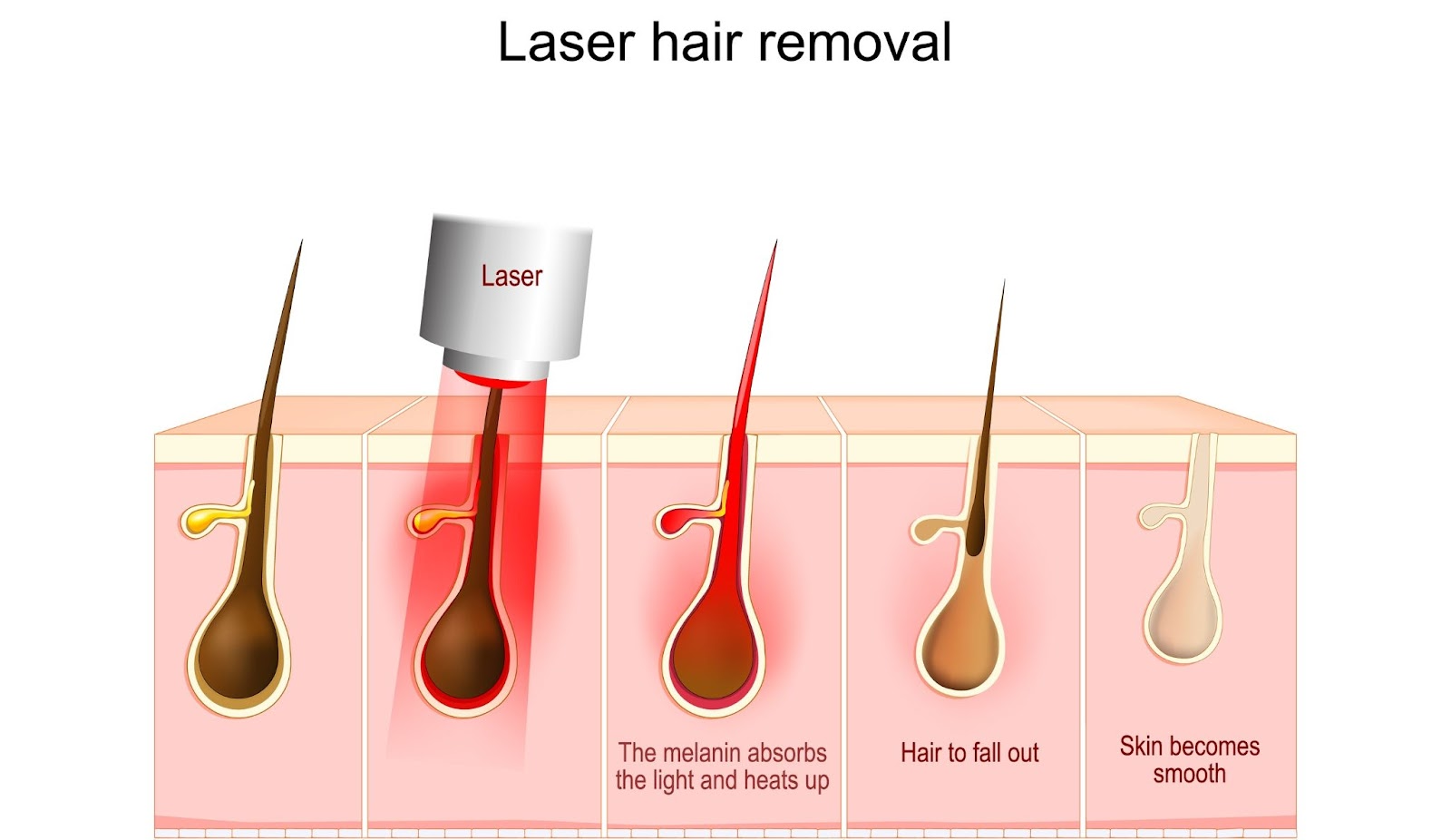 laser hair removal singapore