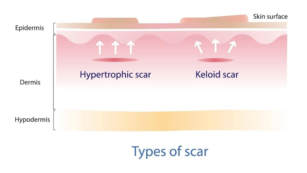 Cause of Keloid and Hypertrophic Scars Singapore