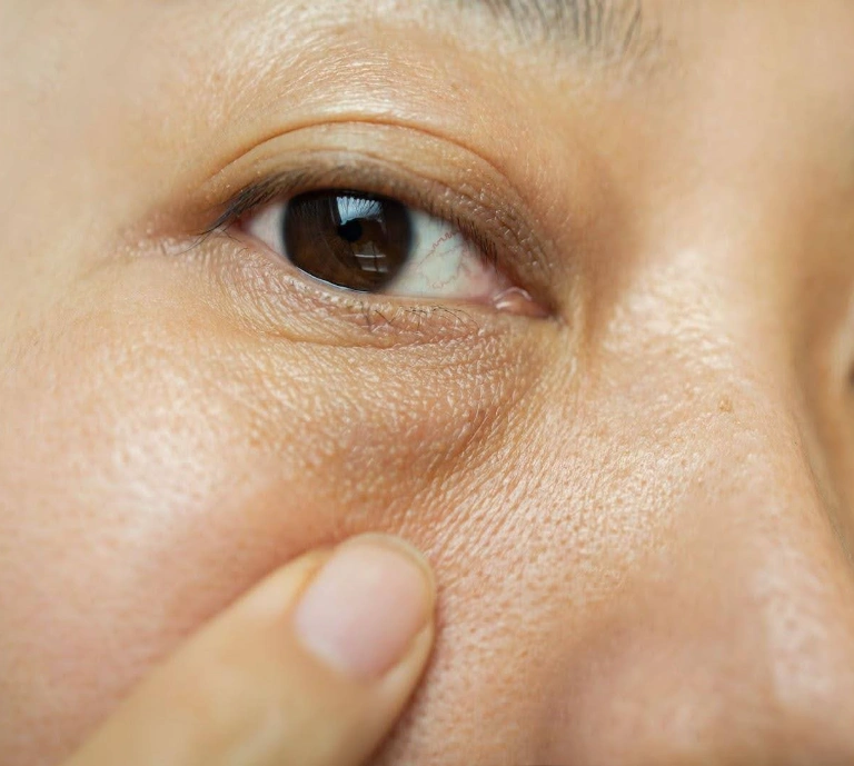 Symptoms of Eye Bags Singapore