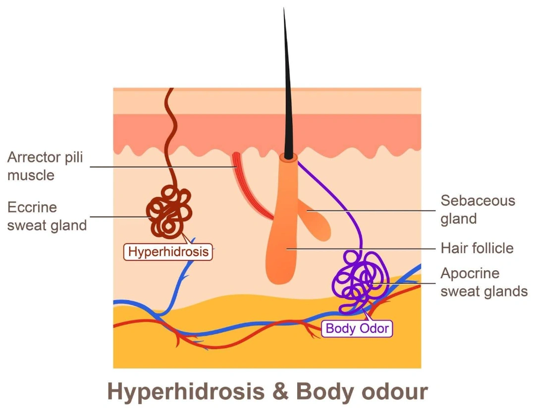 Symptoms of Hyperhidrosis Singapore