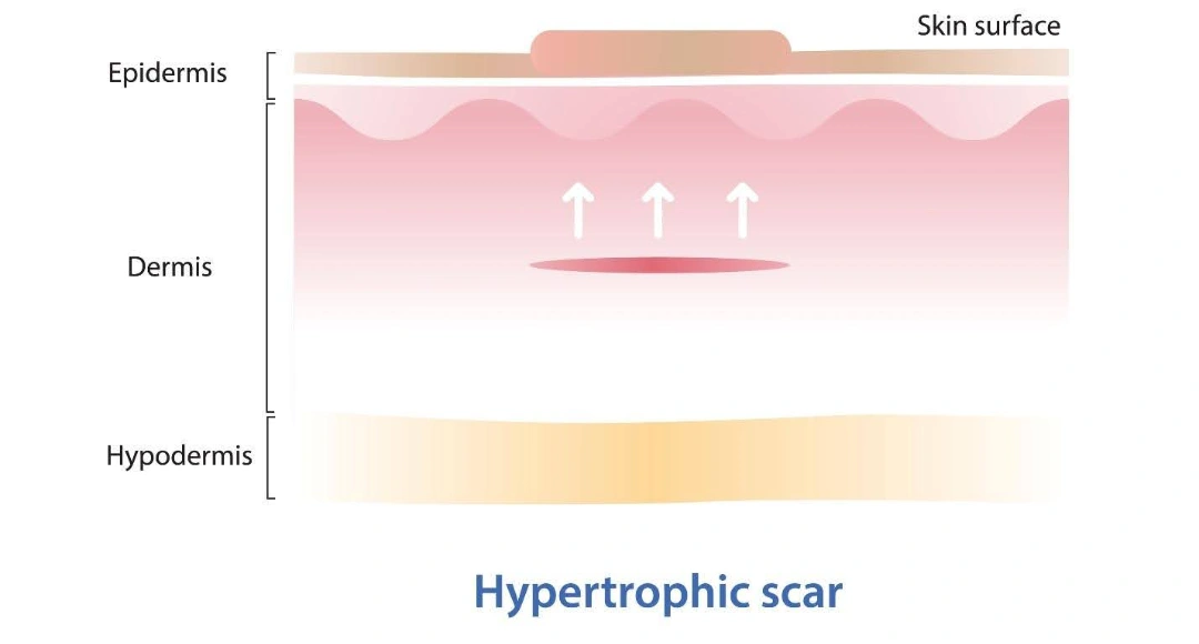 what are hypertrophic scars.