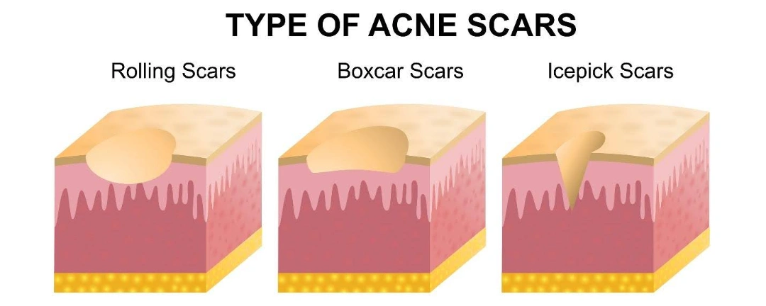 types of acne scars.