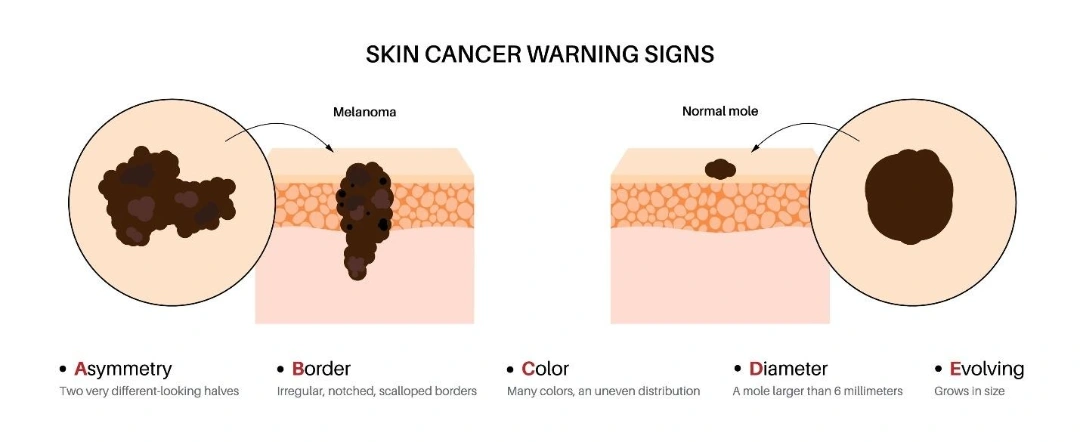 signs of cancerous moles.