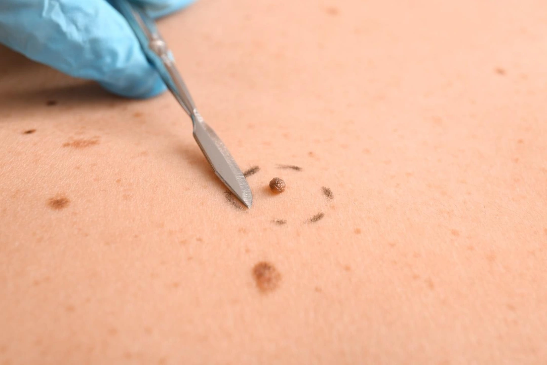 benefits of mole removal.