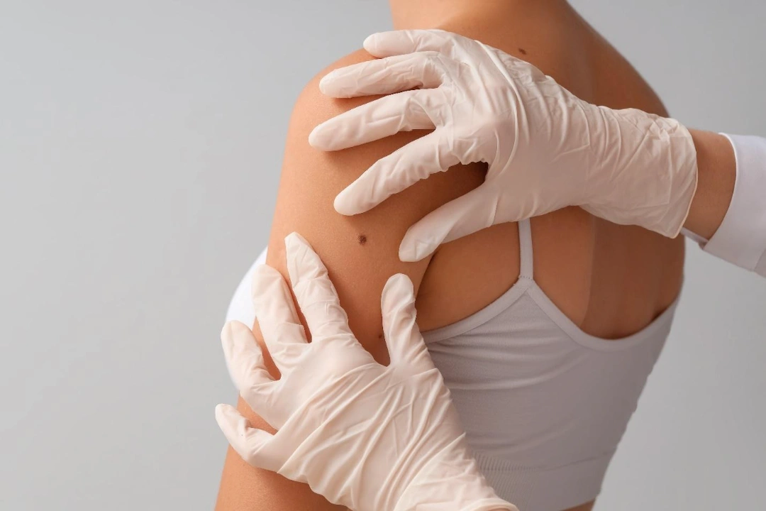 moles skin cancer Singapore.