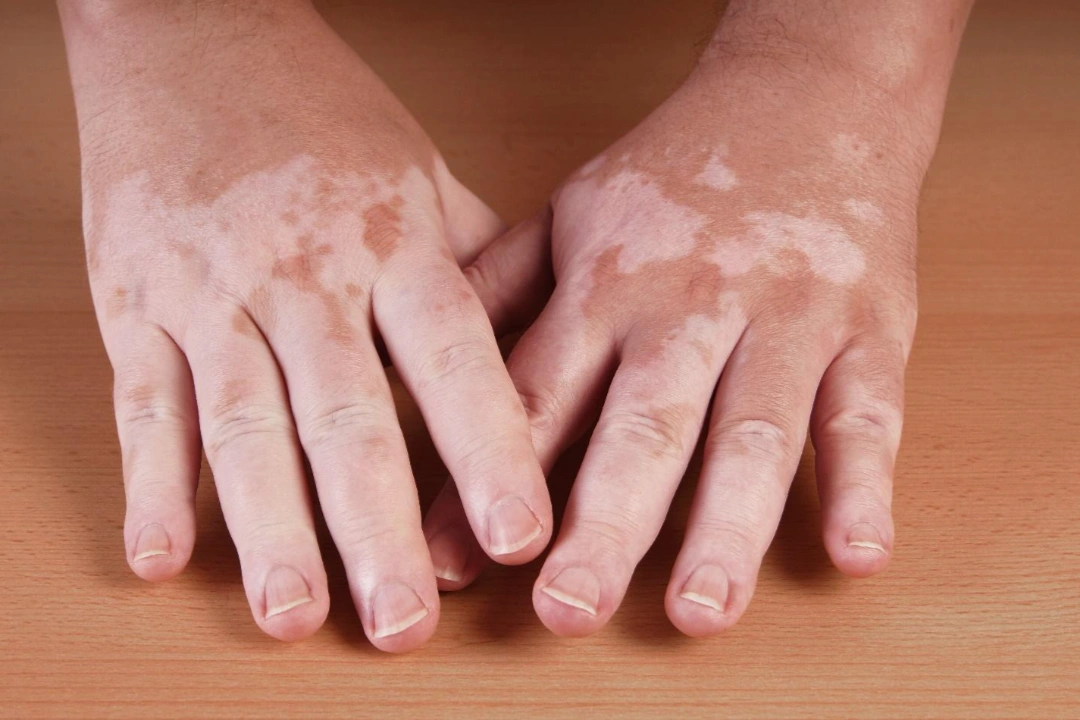 what is vitiligo.