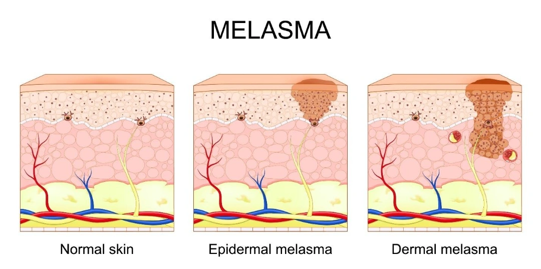 what is melasma.