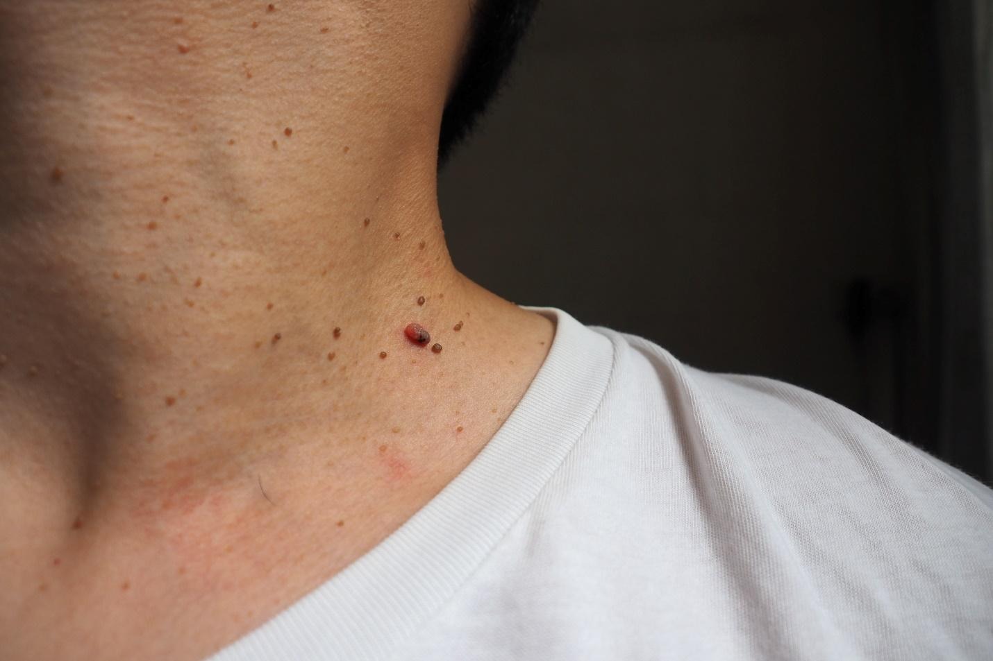 skin tags Singapore.