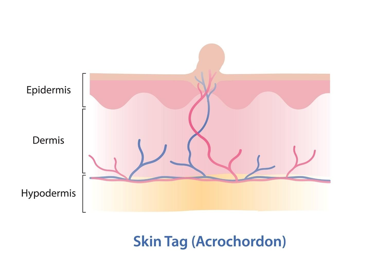 causes of skin tags.