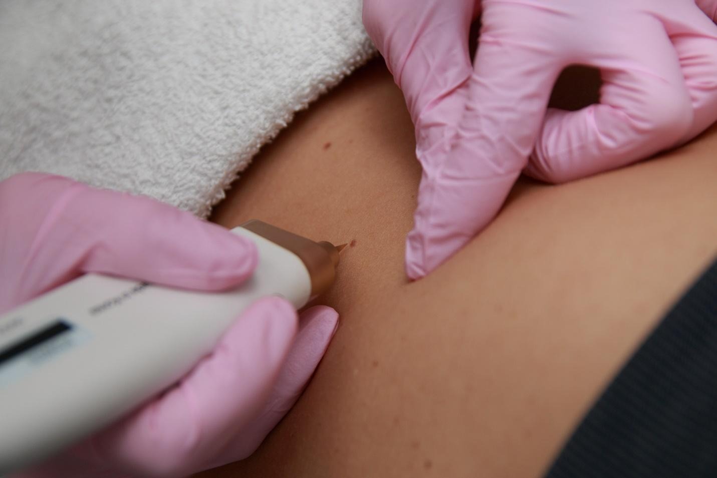 skin tag treatments.