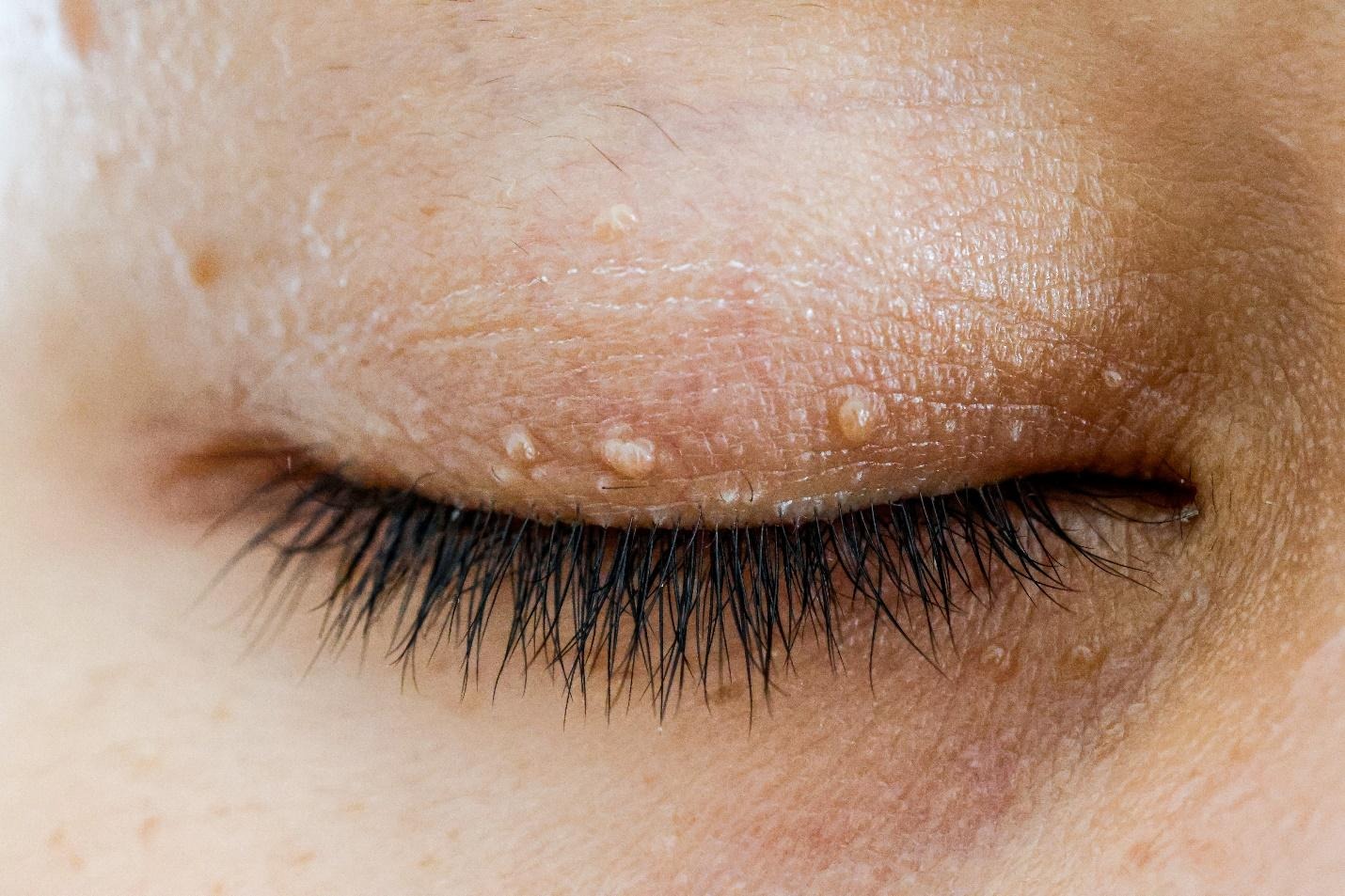 where do skin tags form.