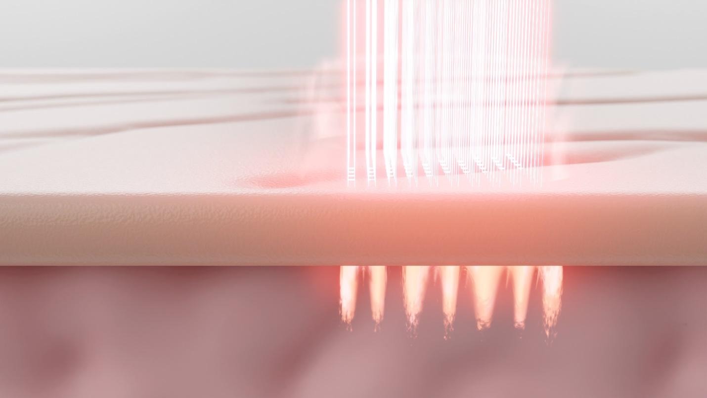 fractional laser Singapore.