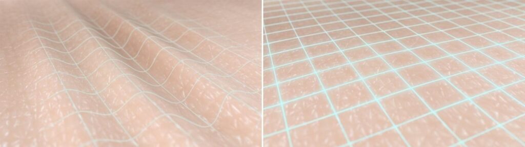 Comparison between radiofrequency skin tightening and thread lift treatment for facial rejuvenation.